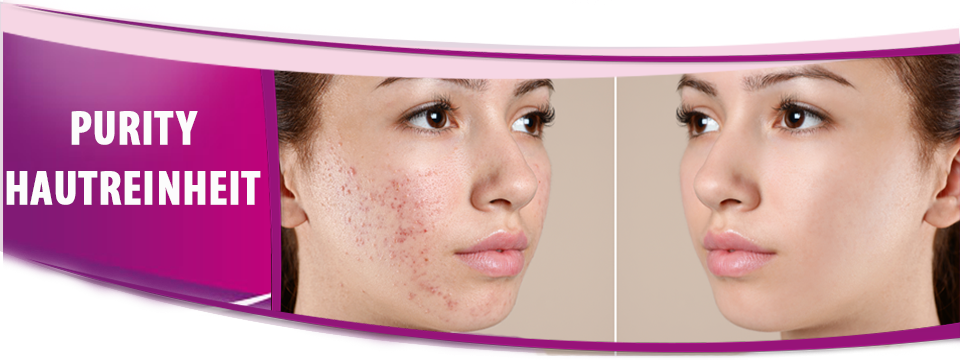 Akne-Behandlung-Hautunreinheiten-und Pickel-beseitigen