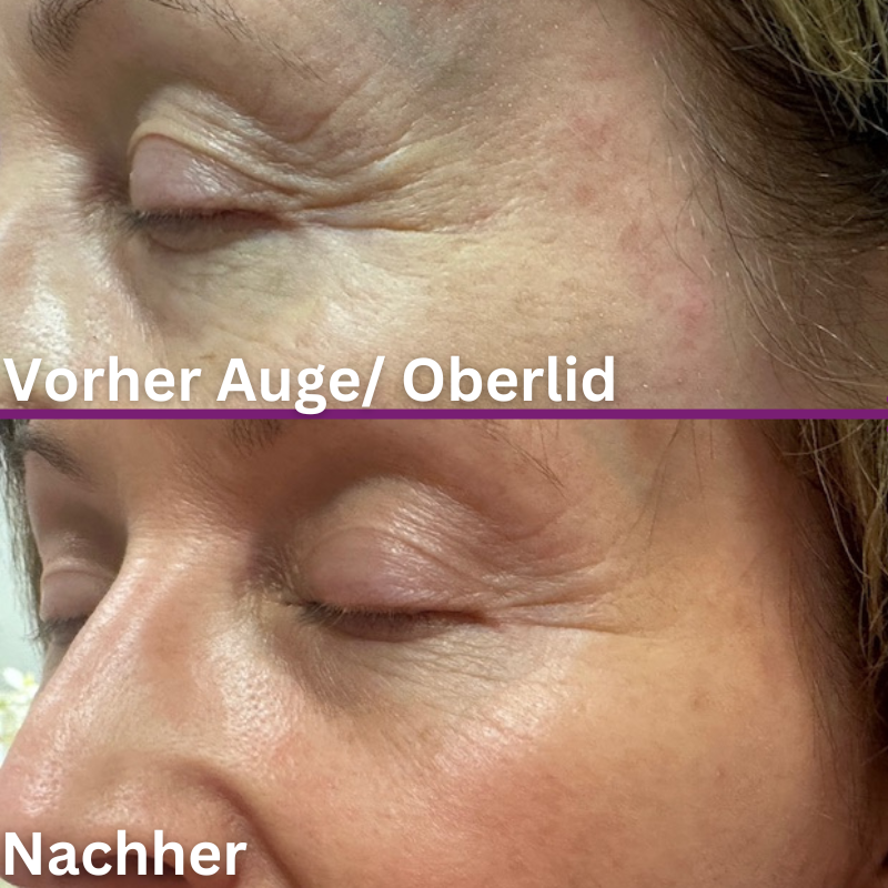 Luxus Radiofrequenz Gesicht Vorher Nachher Bilder