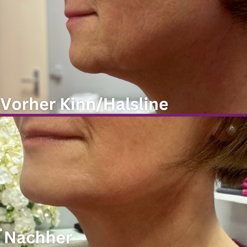 Luxus Radiofrequenz Gesicht Vorher Nachher Bilder