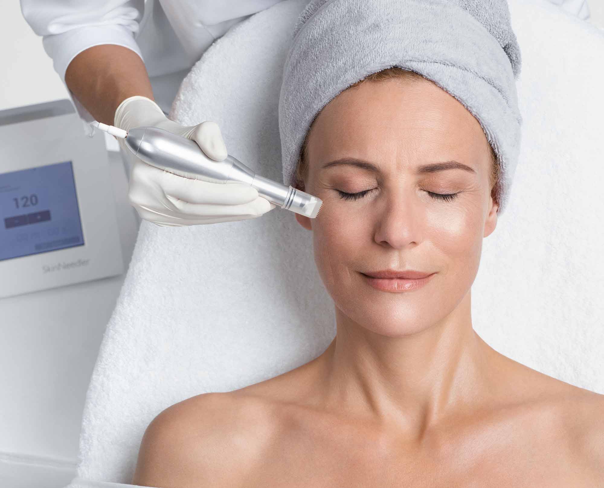 Microneedling zur Hautsstraffung in Berlin Steglitz